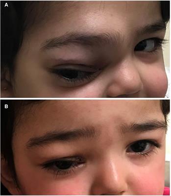 Case Report: Pediatric myeloid/lymphoid neoplasm with eosinophilia and PDGFRA rearrangement: The first case presenting as B-lymphoblastic lymphoma